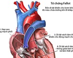 Các bệnh tim bẩm sinh thường gặp