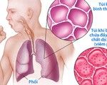 Hiểu đúng về viêm phổi
