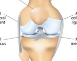 Điều trị thoái hóa khớp gối - Kỳ 1: Bảy nguyên nhân đau đớn