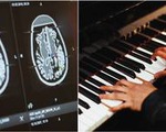 Kỳ lạ nghệ sĩ chơi piano trong khi được phẫu thuật não
