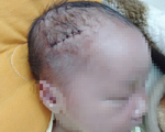 Bé trai sinh mổ bị dao cắt rách đầu, khâu 6 mũi