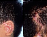 Tạo hình tai bằng... sụn sườn tự thân