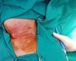 Suýt tử vong chỉ vì hóc xương cá
