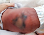 Mẹ nằm bếp than sau sinh, con bị hoại tử da vì bỏng nặng