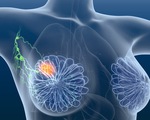 Thuốc bổ làm tăng nguy cơ tái phát ung thư vú
