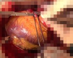 Cứu sống bệnh nhân vỡ tim sau khi bỏ qua quy trình thông thường