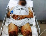 Việt kiều về quê ăn tết bị tạt axit, cắt gân chân