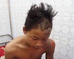 Gặp cậu bé may mắn thoát chết dù bị sét đánh trúng đầu