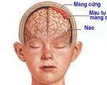 Máu tụ dưới màng cứng