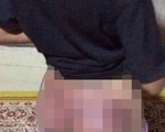 Công an viên dùng dùi cui cao su đánh bé gái thiểu năng nhập viện