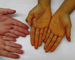 Dấu hiệu nhận biết bệnh gan các 