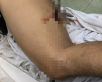 Ngã tại công trường, một công nhân bị thanh sắt đâm xuyên đùi