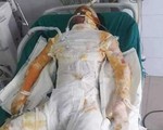 Đang giao ca thì sụt lò luyện gang, công nhân bỏng 80% cơ thể