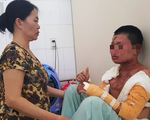 Nam sinh bị bỏng nặng vì bếp cồn trước ngày thi THPT