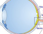 Teo dây thần kinh thị giác: Bệnh thường gặp ở người lớn tuổi