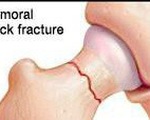 Làm sao nhận biết người già bị gãy xương khớp háng?