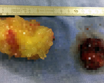 Mổ lấy 2 khối u nhầy di động trong buồng tim bệnh nhân