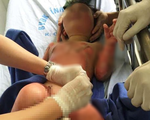 Cô giáo đốt cồn dạy phòng chống cháy nổ làm 3 trẻ mầm non bỏng nặng
