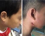 Phát hiện số ca bệnh whitmore do vi khuẩn 