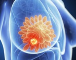 Dùng liệu pháp hóc môn sau mãn kinh tăng nguy cơ tử vong do ung thư vú