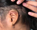 Tạo hình cánh mũi, vành tai bị đứt lìa cho hai nạn nhân bị tai nạn