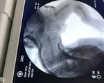 Bé trai sơ sinh ở Quảng Nam bị gãy xương đùi khi sinh mổ