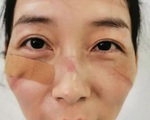 Bác sĩ ở Vũ Hán phải mặc tã làm việc, bị đánh và thiếu tiếp tế
