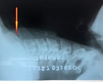 Xương cá đâm thủng thực quản do cố 