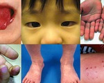 Trẻ nhiễm COVID-19 mắc hội chứng lạ giống Kawasaki: làm sao phân biệt hai bệnh?