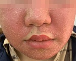 Mặt sưng phù, đầy mụn mủ sau khi đắp mặt nạ mua trên mạng