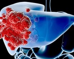 The truth about liver cancer