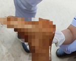 Một thiếu niên 15 tuổi bị chặt đứt chân phải vì mâu thuẫn cá nhân