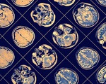 Phần mềm AI của IBM giúp chẩn đoán diễn tiến bệnh Parkinson