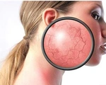 Sử dụng thuốc ngoài da chứa Corticoid liệu có ‘thần thánh’ như bạn nghĩ?