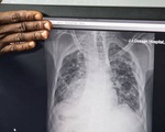 WHO báo động bệnh nhân lao tăng đột biến, 1,6 triệu người chết năm ngoái