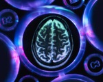 Giấc ngủ ngày dài hơn là dấu hiệu ban đầu của bệnh Alzheimer