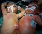 Kon Tum: Phẫu thuật tách cặp song sinh dính nhau