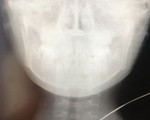 ​Bé trai&nbsp;bị cọng sắt&nbsp;đâm xuyên cổ