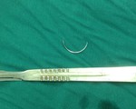 Mổ lấy kim khâu quên trong bụng bệnh nhân 15 năm