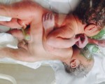 Hai bé trai sinh đôi dính liền từ bụng đến rốn