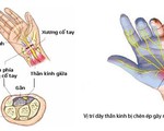 ​Hội chứng ống cổ tay – căn bệnh nhân viên văn phòng thường gặp