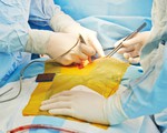 Ghép thành công thực quản nhân tạo lần đầu tiên trên thế giới