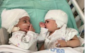 Tách thành công trẻ sinh đôi dính đầu ở Israel