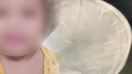 Video: Điều tra nhân tình của người mẹ vụ 'bé gái 3 tuổi có 9 vật thể giống đinh găm vào hộp sọ'