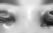 Cô gái trẻ bị mù sau khi cắt mí mắt tại spa