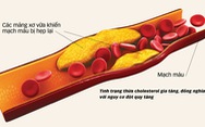 Kiểm soát thừa cholesterol: giảm 27% nguy cơ đột quỵ