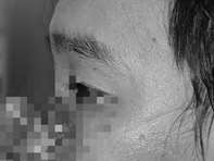 Người đàn ông mang khối u to trên mũi đã có gương mặt gần như bình thường