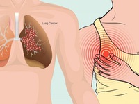 10 dấu hiệu cảnh báo sớm bệnh ung thư phổi