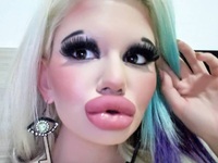 Cô Emi tiêm filler môi 