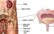 Không vô nhà vệ sinh kịp thì són tiểu là bệnh gì?